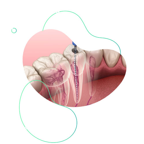 Первичное-лечение-1о-канального-зуба