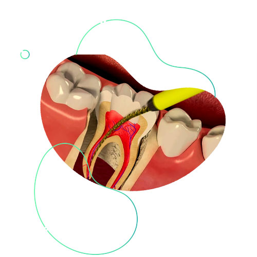 Первичное-лечение-2х-канального-зуба-
